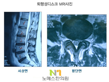 퇴행성 디스크가 발생하는 이유는? 3