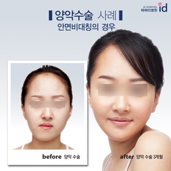 안면 비대칭 수술에 대한 자세한 양악 수술 리뷰를 살펴보겠습니다. 4