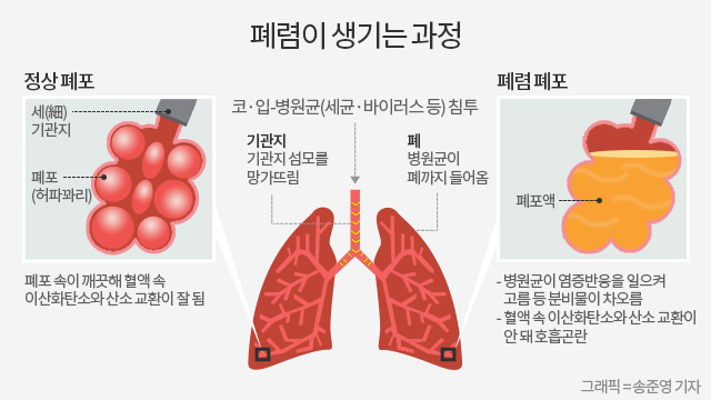 예방법 폐렴 폐렴 증상