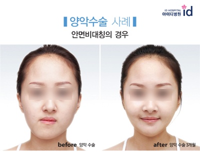 안면 비대칭 수술에 대한 자세한 양악 수술 리뷰를 살펴보겠습니다. 11