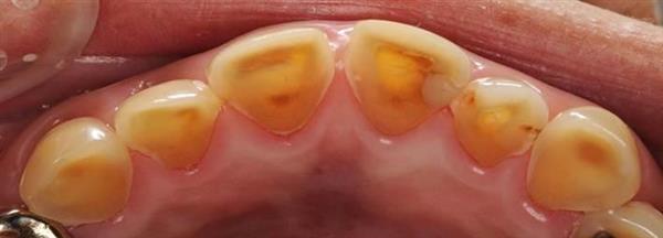 スポーツドリンクやレモンで歯が溶ける だらだら食べは 酸蝕歯 のもと 1 2ページ 産経ニュース