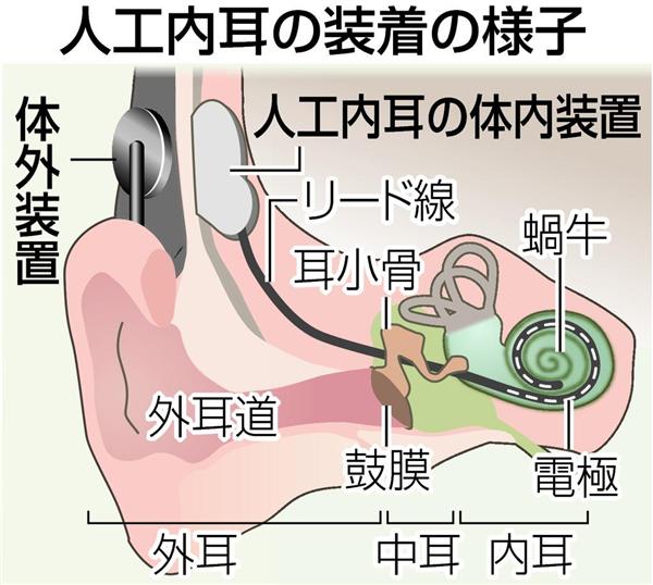 人工内耳」が広い年齢層で活用 高齢者では認知症予防に期待（1/4ページ ...