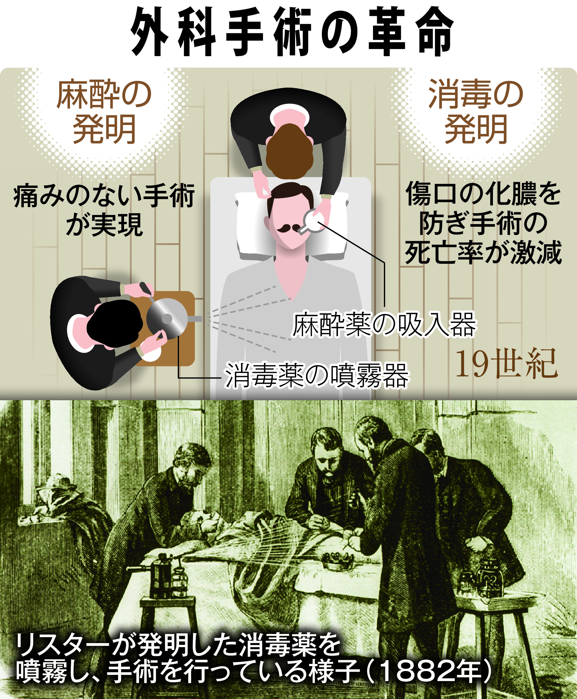 外科手術 AIが医師にリスク回避など助言 ロボットで自動化に道、医療は