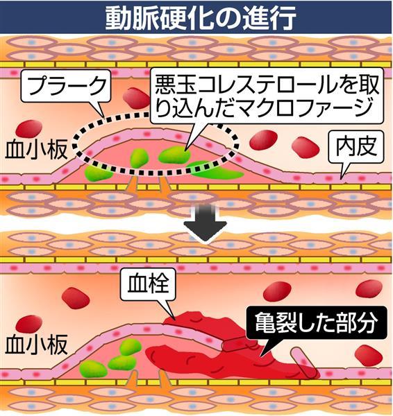 遺伝子に異常 家族性高コレステロール血症 新薬続々 悪玉 の分解を促進 生活習慣病と混同しないで 1 3ページ 産経ニュース