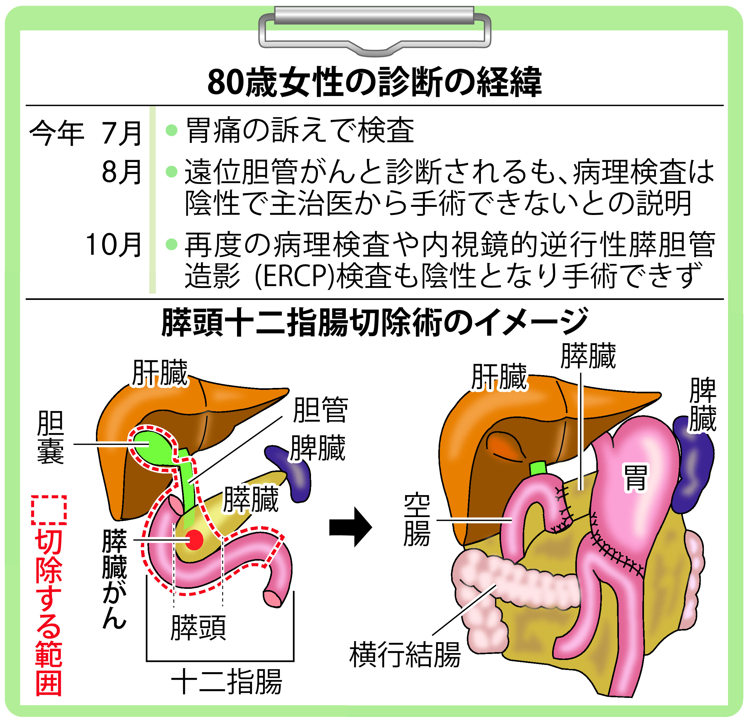 がん電話相談から】胆管がん疑い、確認とれず手術不能 - 産経ニュース