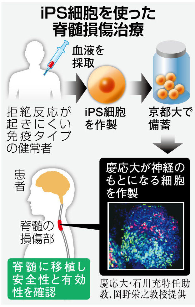 半年以上経過の患者にも期待 iPS脊髄損傷治療 - 産経ニュース