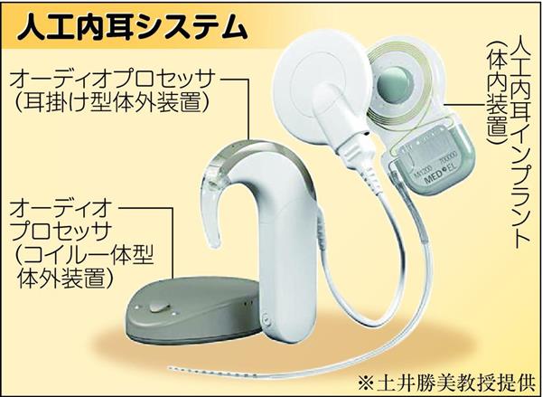 高度難聴者の人工内耳進化 小型・高性能に 保険適用も拡大（1/3ページ） - 産経ニュース