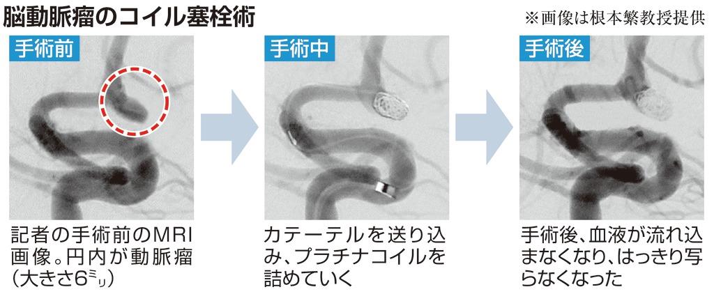 １００歳時代プロジェクト】脳動脈瘤治療体験記 クモ膜下出血、画像