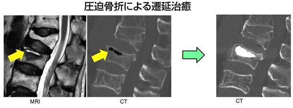骨粗鬆症による圧迫骨折 早期診断で生活の質向上（3/3ページ