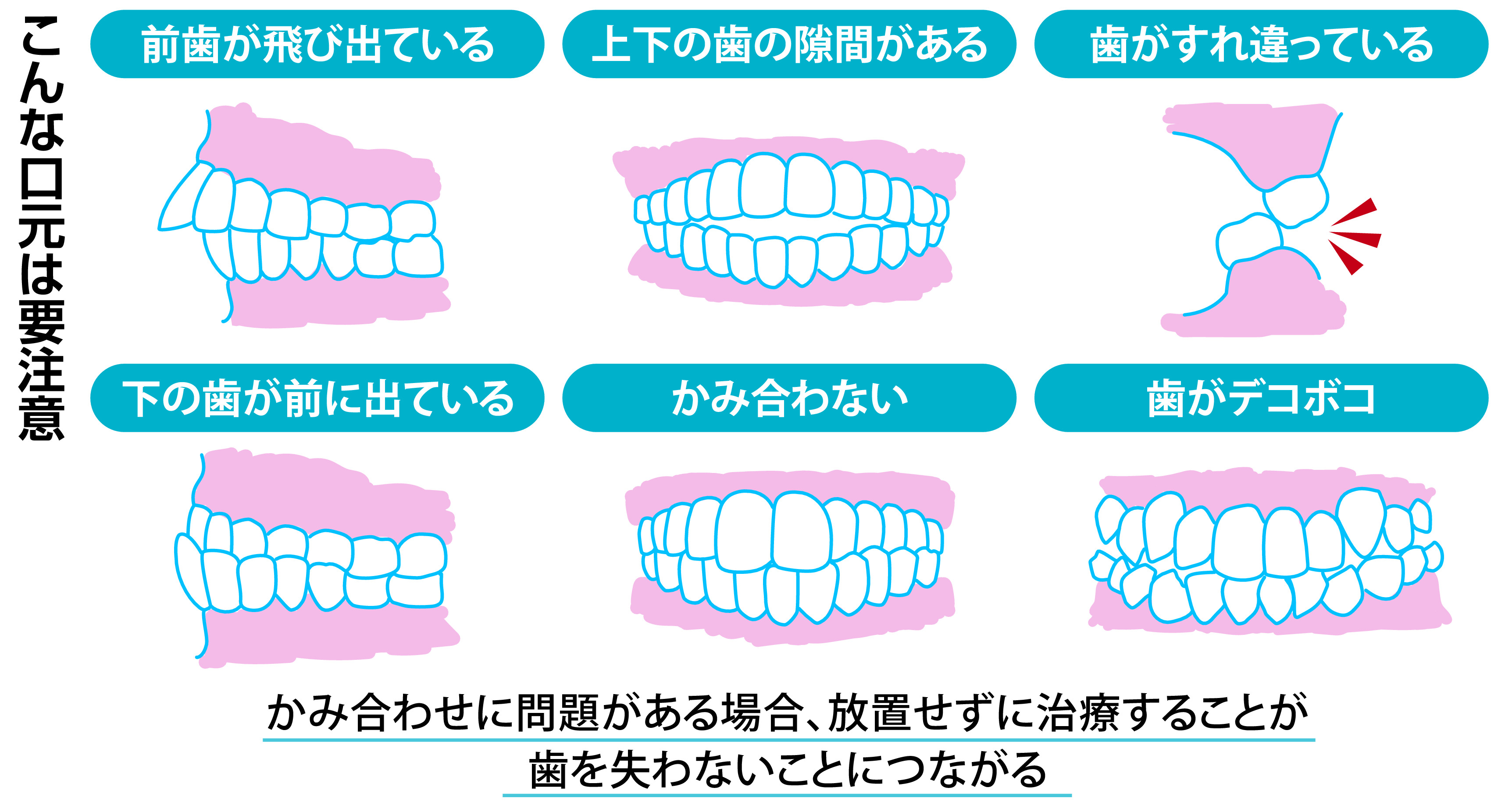 医療用　歯科矯正　マスク マスク生活で増えた？歯列矯正 中高年からのポイントは - 産経ニュース