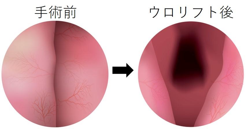 前立腺肥大症・最新治療】最新の手術法「WAVE」と「ウロリフト