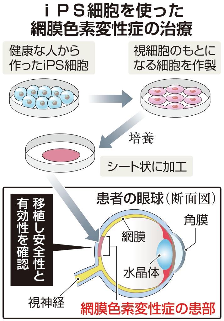 iPSで「網膜色素変性症」治療 神戸の病院の計画了承（写真・画像 1