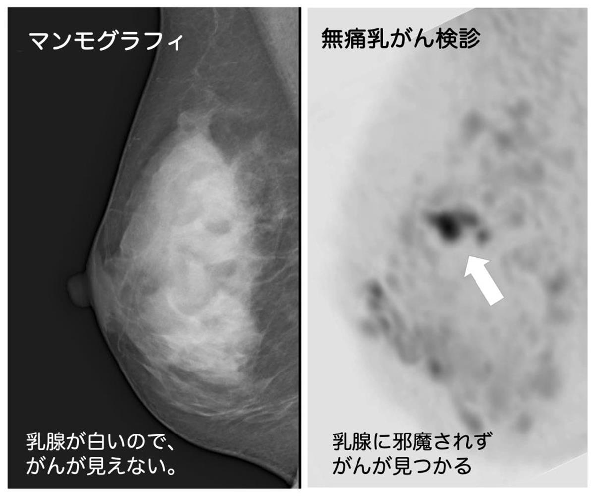 徹底解説「無痛検査」最新事情】乳がん早期発見へ「ドゥイブス法