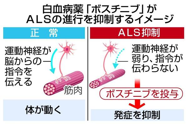 難病 ａｌｓ の進行抑制物質を京大グループがｉｐｓ細胞使い発見 患者ら治療薬を 少しでも早く と期待 1 2ページ 産経ニュース