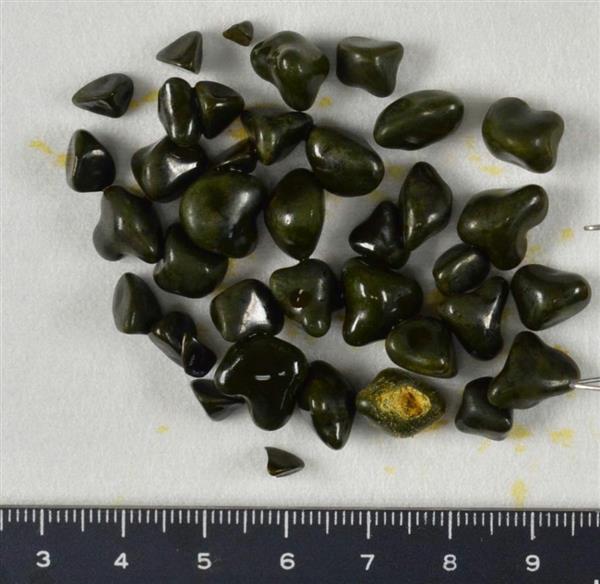 胆のう胆管の病気に気をつけろ！】胆石ができた場合、必ず手術が必要