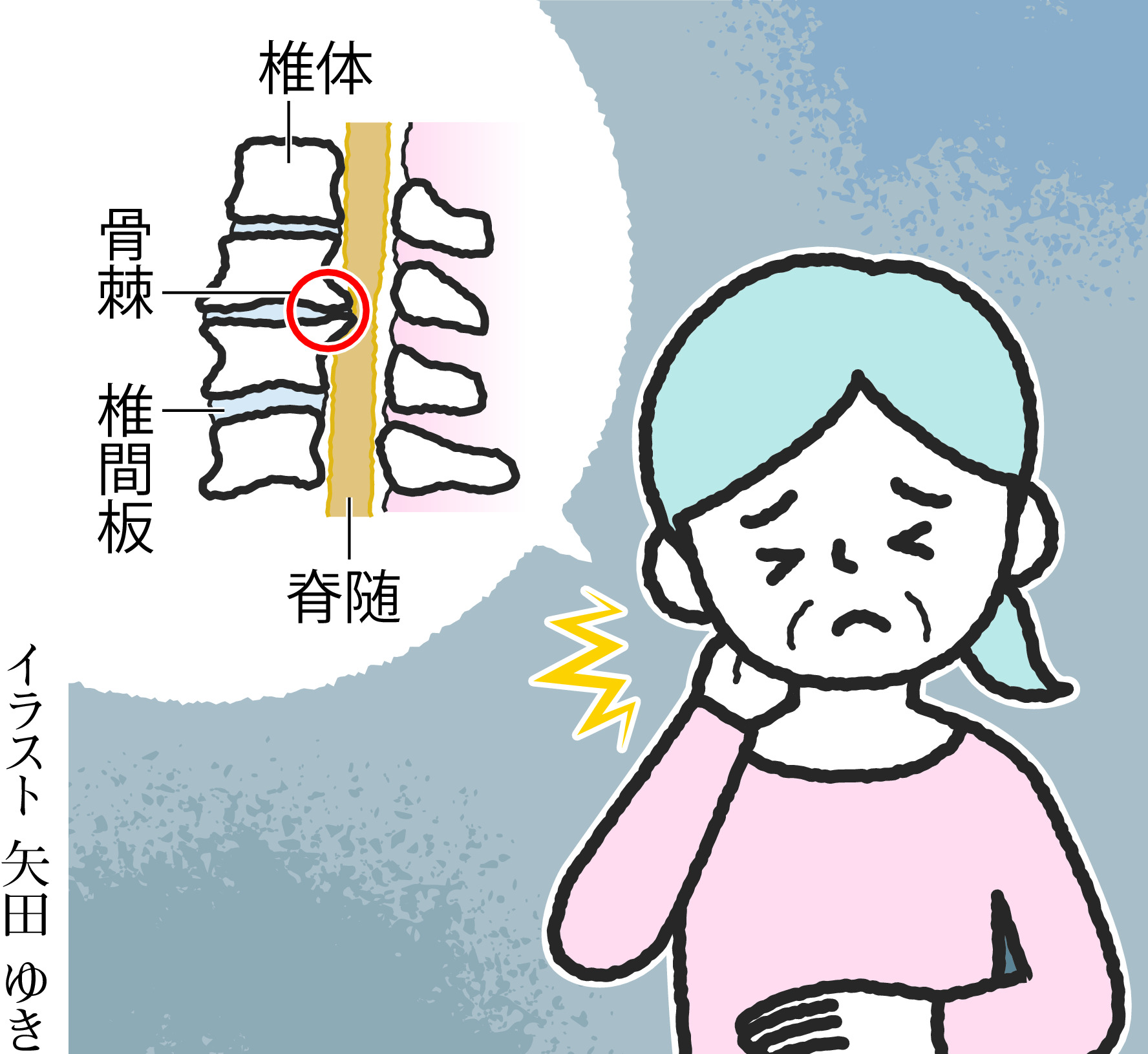 頚椎症 高齢者の約9割で頸椎に変化 加齢が原因 痛み学入門講座 - 産経