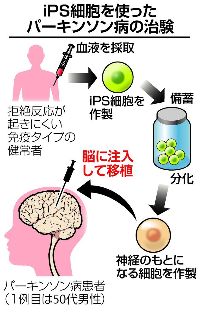 がん化リスク 慎重に検証必要 パーキンソン病のｉｐｓ治験 産経ニュース