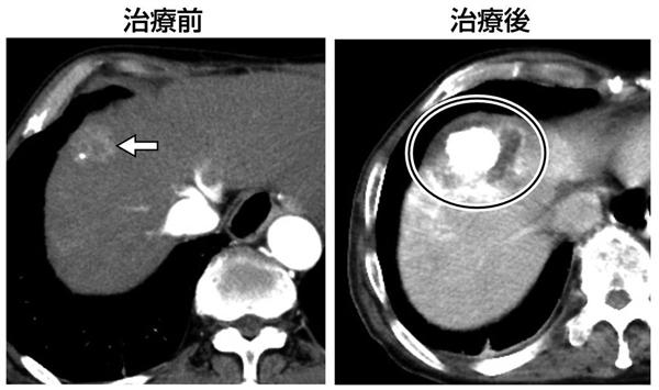 肝臓がんにラジオ波焼灼療法 患者の負担軽減 再発にも対応 1 3ページ 産経ニュース