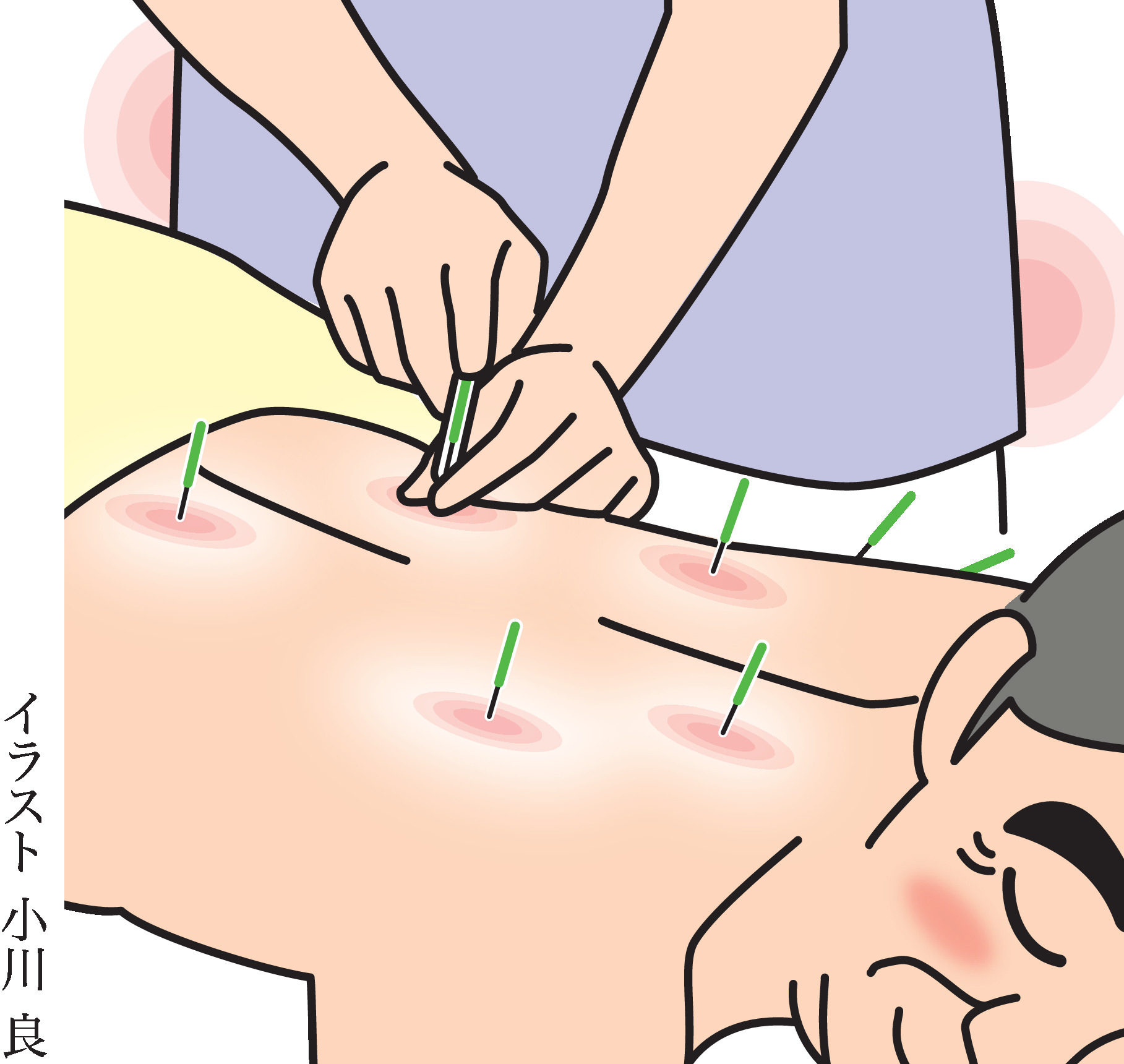 よくわかる鍼灸治療 II Vol.1 よくわかる鍼灸治療 II Vol.1