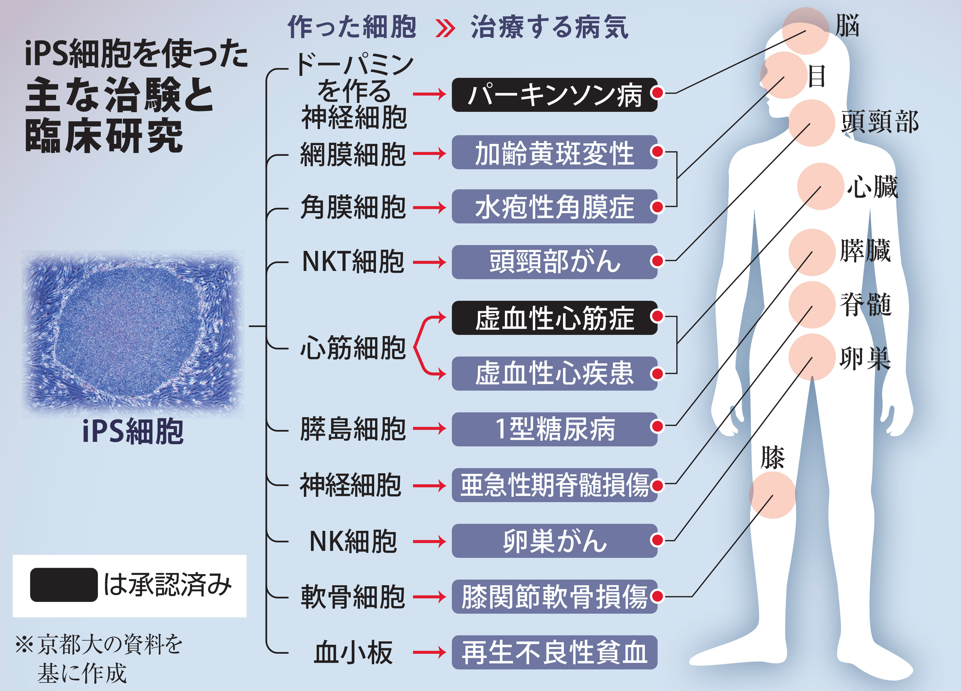 がん、脊髄損傷、眼病…iPS再生医療、実用化へ向け多様な治験や臨床研究
