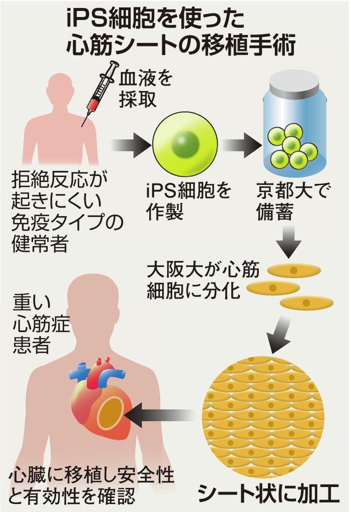 進んだｉｐｓ臨床研究 命を救う 新たな段階へ 1 3ページ 産経ニュース