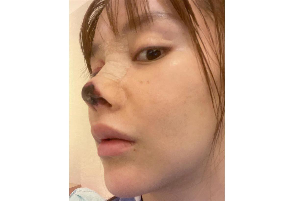 中国の女優が美容整形の失敗公表 壊死の写真で警鐘 産経ニュース