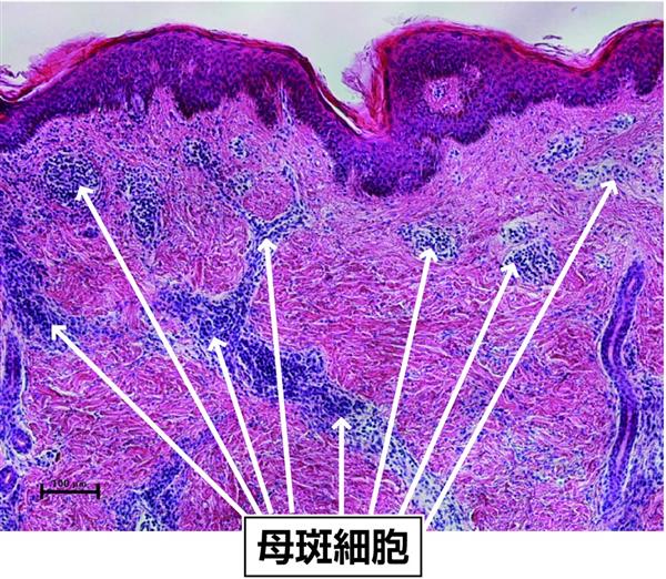 先天性巨大色素性母斑の治療法確立へ 世界初の皮膚再生移植 1 3ページ 産経ニュース