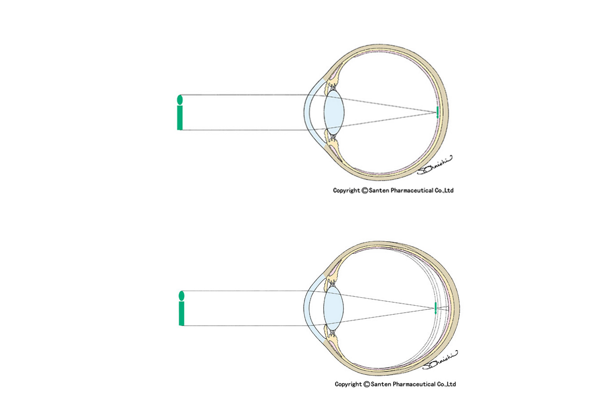 それって「アイフレイル」かも？ 眼球の“変形”が引き起こす失明