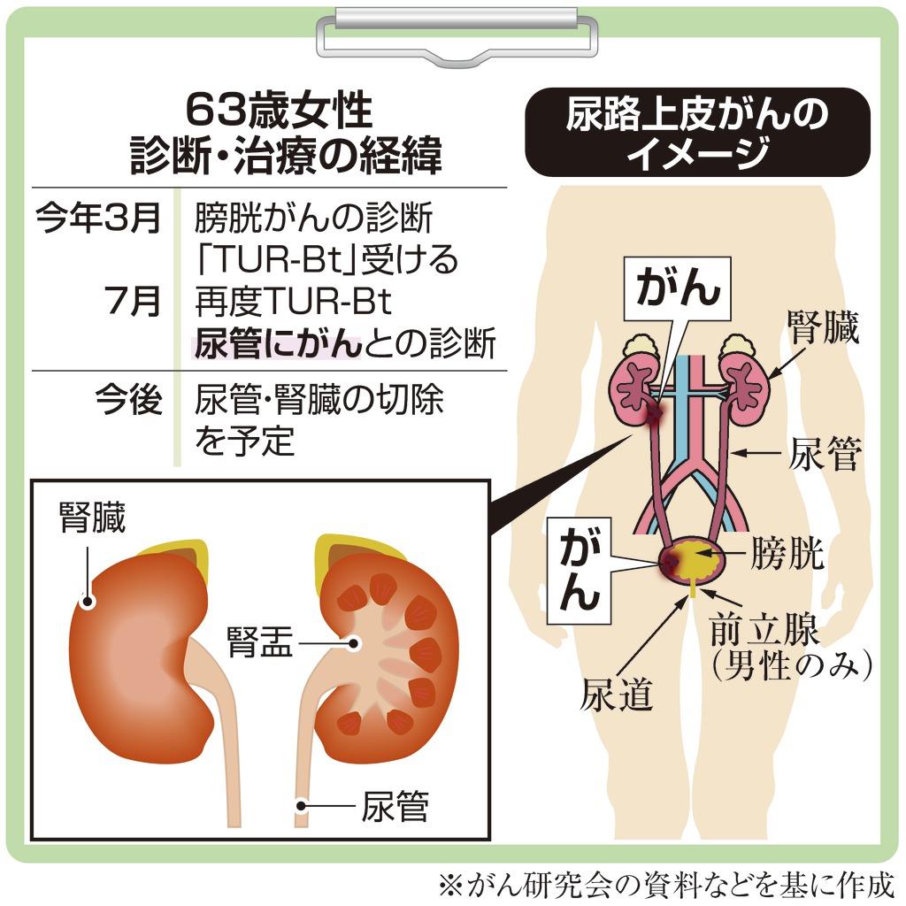 がん電話相談から】尿管がんでなぜ腎臓を取るのか（1/2ページ