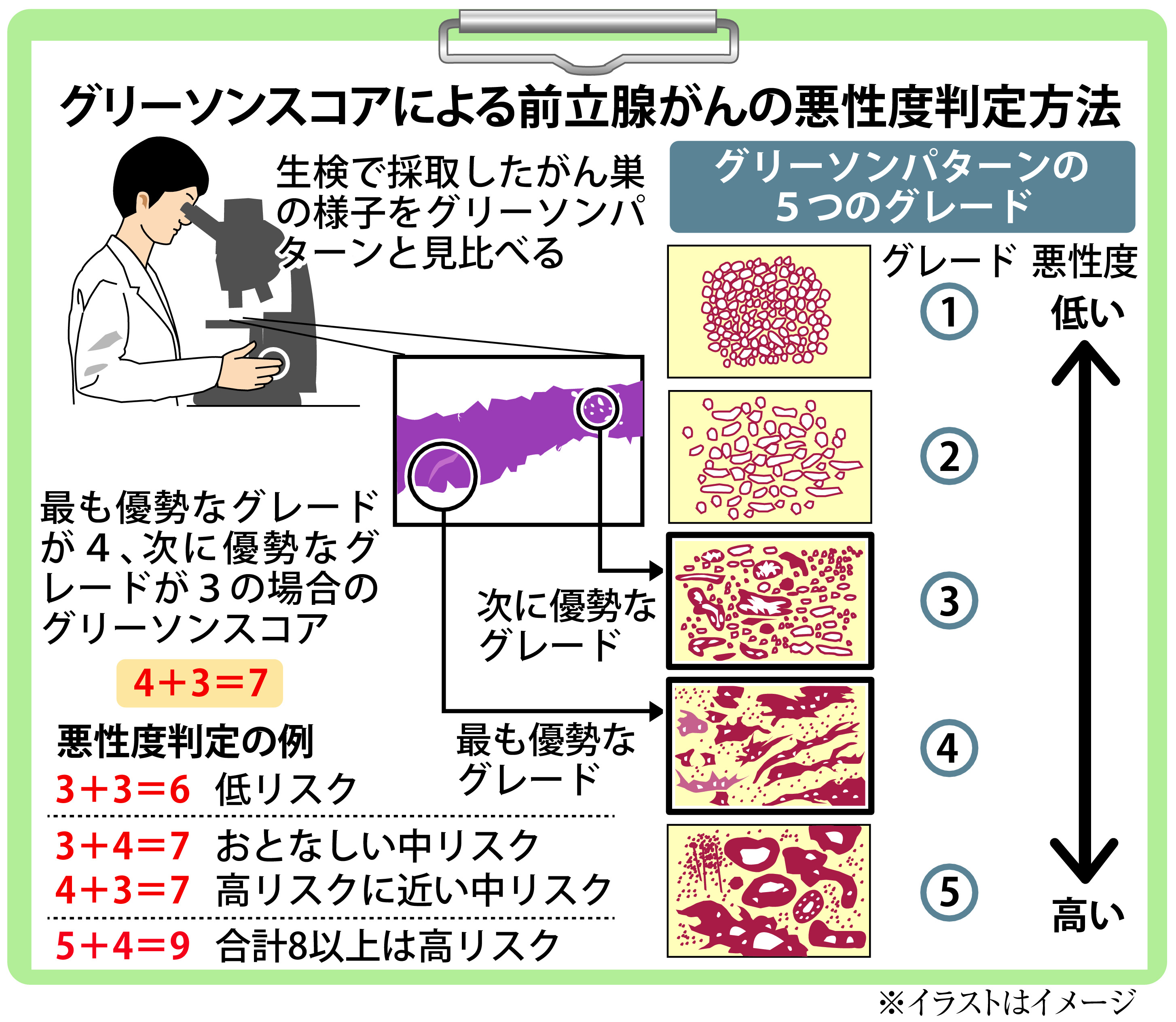 がん電話相談】ＰＳＡ値が急上昇、前立腺がん？ 生検受けて診断確定を - 産経ニュース