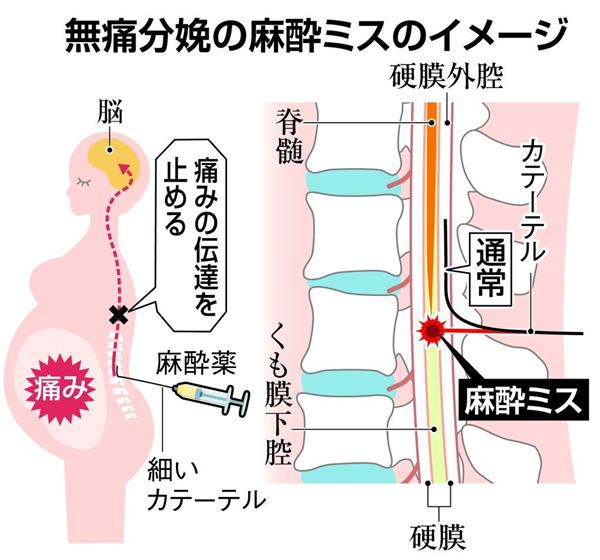 無痛分娩死亡 きょう書類送検 業務過致死容疑で院長 麻酔ミス対応怠る 大阪府警 1 3ページ 産経ニュース