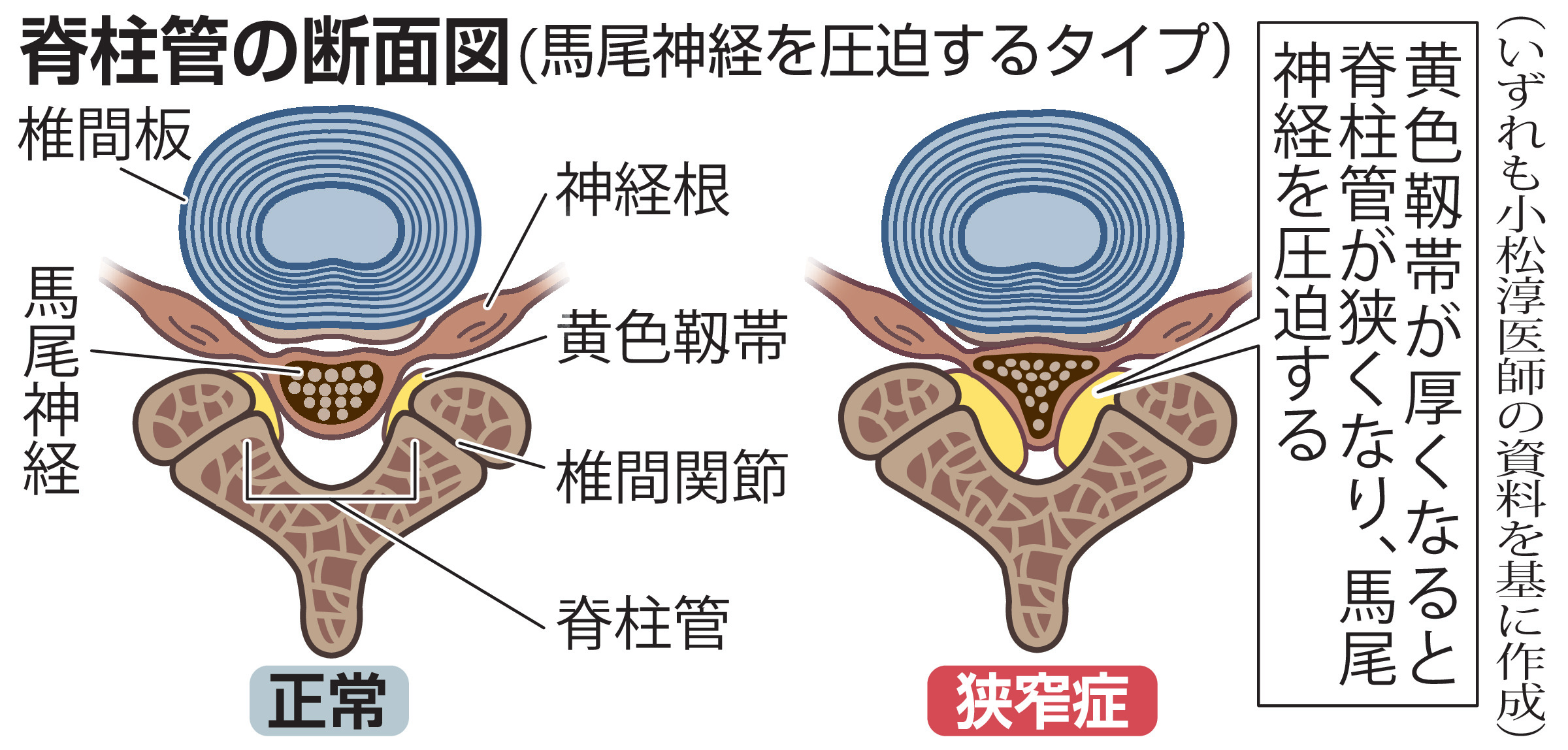歩けなくなる「脊柱管狭窄症」 痛みを我慢せず、早い受診が健康