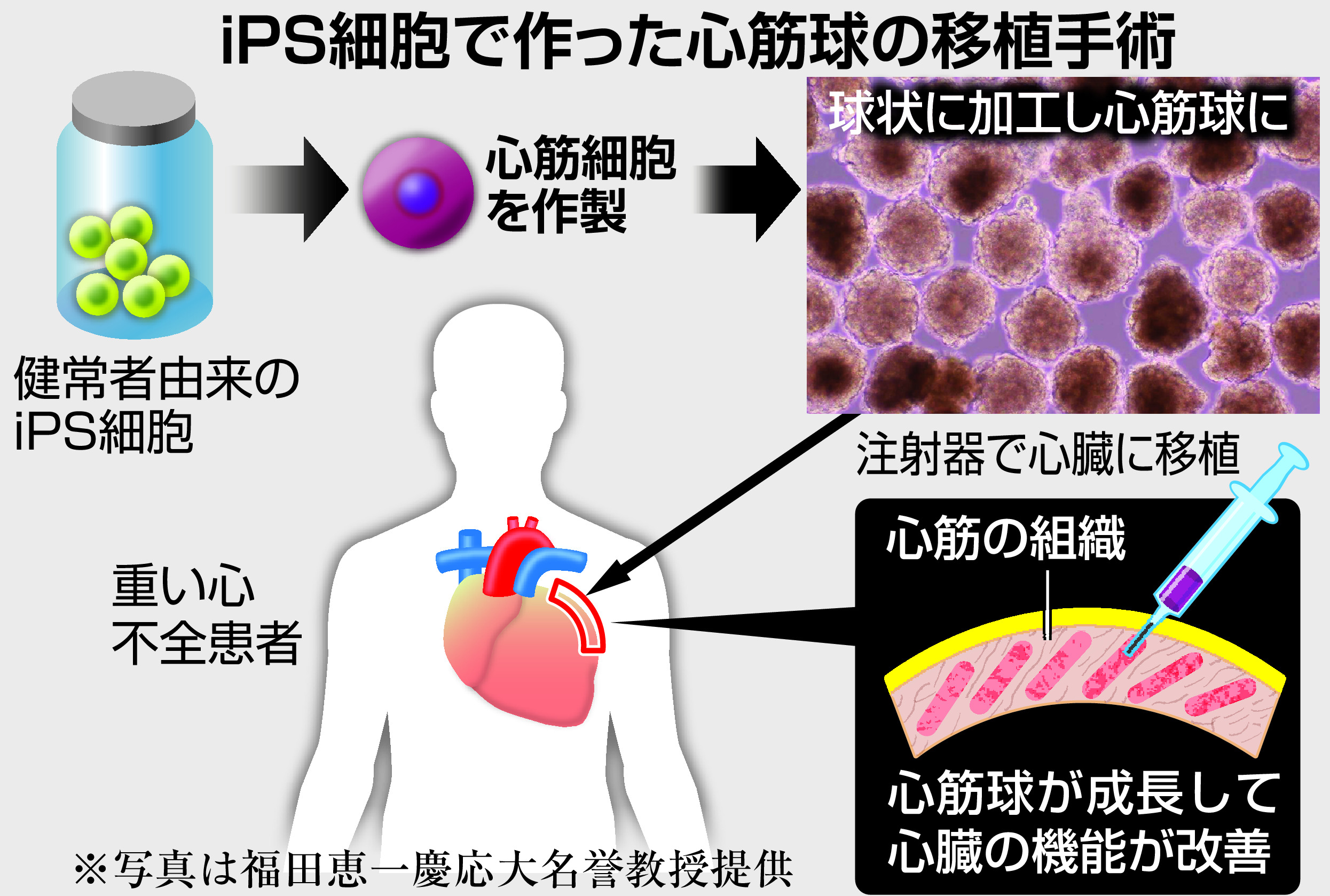心不全治療の新たな道 iPS心筋球移植が高い効果 開胸手術不要になる
