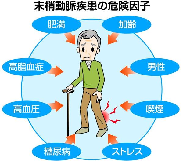 手足のしびれ 痛み 末梢動脈疾患に注意 動脈硬化が広がる危険性 1 4ページ 産経ニュース