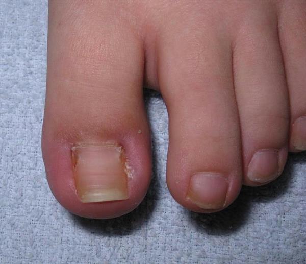 子供の爪のケアどうする トラブル避けるには切りすぎや靴にも注意 1 3ページ 産経ニュース