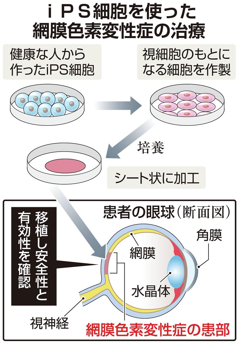 失明患者の再生医療へ一歩 ｉｐｓ細胞の移植成功で 産経ニュース