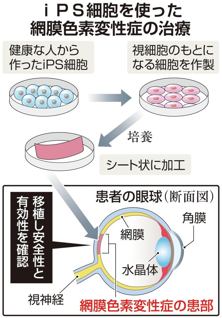 iPSで網膜色素変性症を治療 神戸市立病院が計画申請 - 産経ニュース