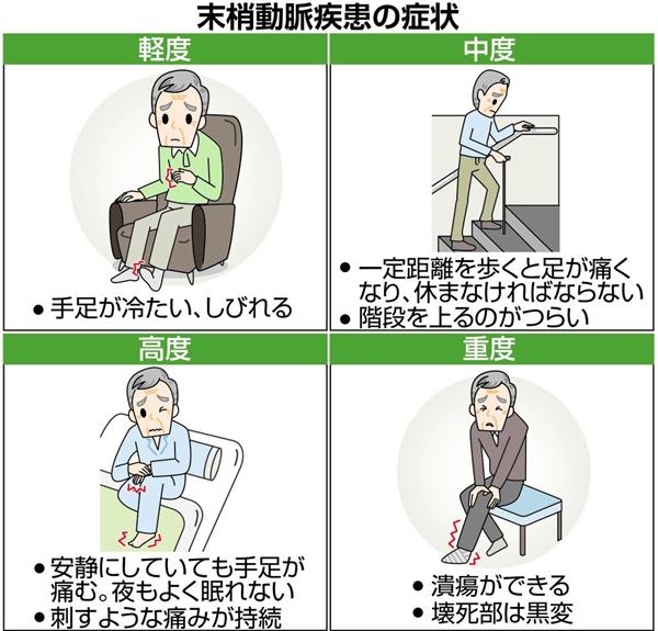 手足のしびれ 痛み 末梢動脈疾患に注意 動脈硬化が広がる危険性 1 4ページ 産経ニュース