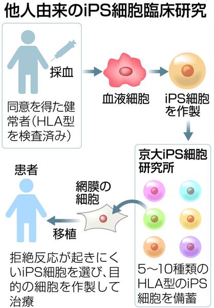 ｉｐｓ網膜再生再開 待ち望む患者に光明 京大 細胞ストック 活用で時間 コスト大幅縮減 1 2ページ 産経ニュース