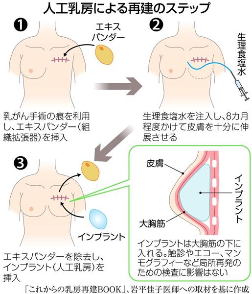 乳がんと闘う】乳房再建術はここまできた！ 人工乳房、インプラントも